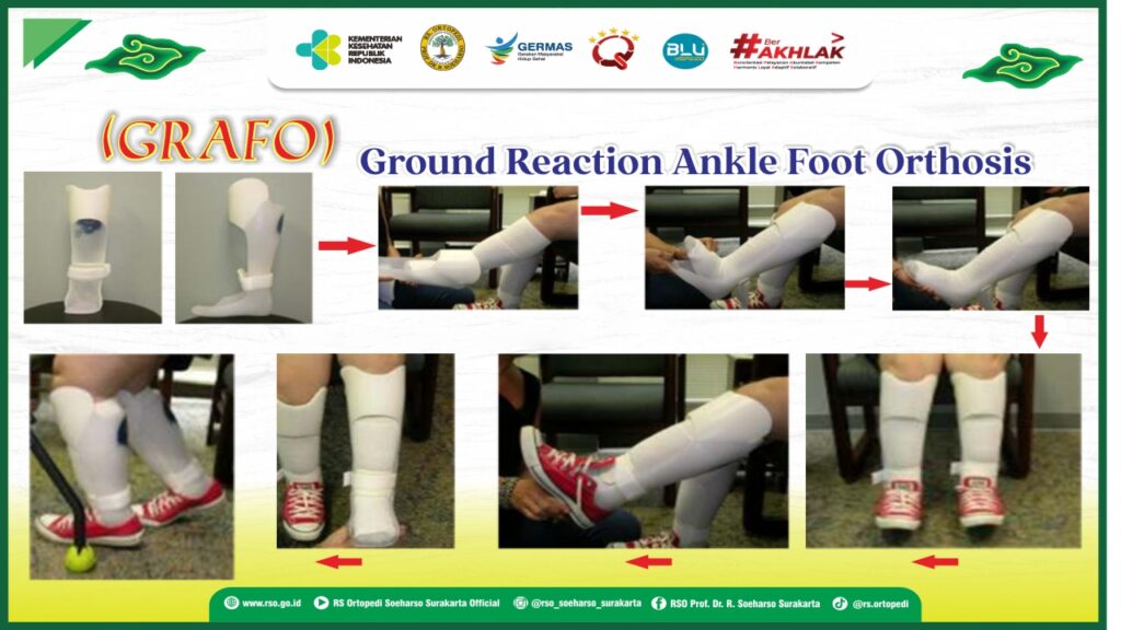 Ground Reaction Ankle Foot Orthosis (GRAFO)