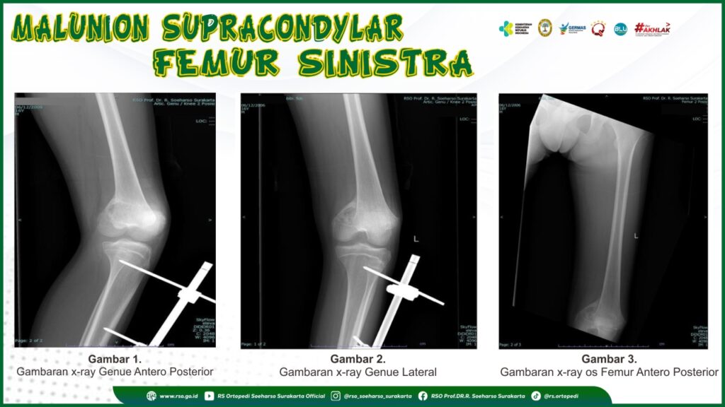 Malunion Supracondylar Femur Sinistra