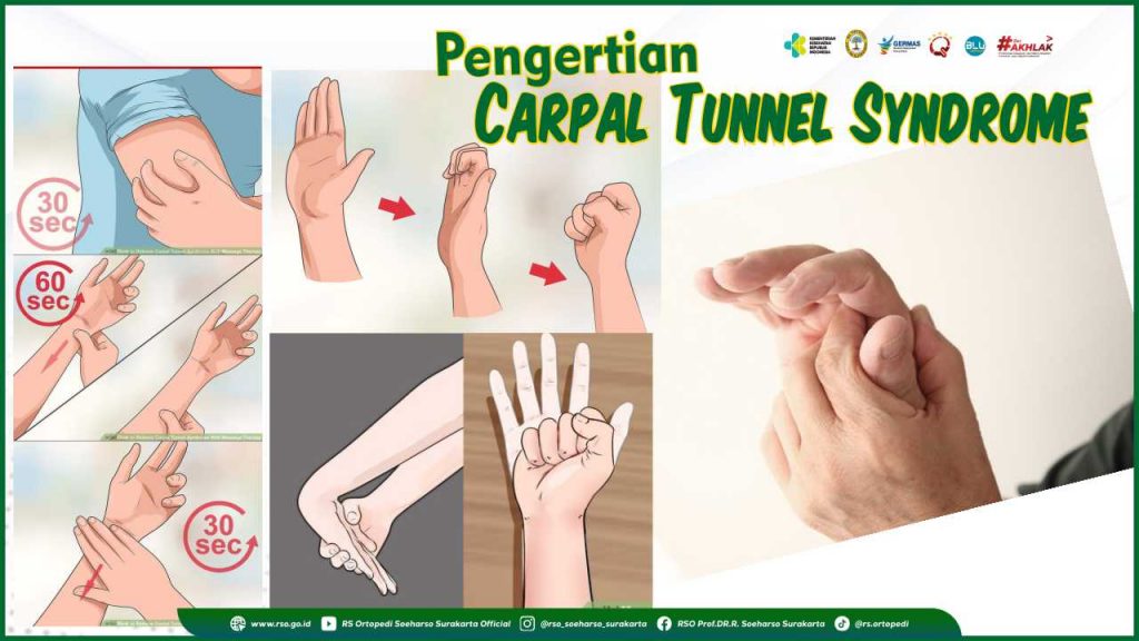 Carpal Tunnel Syndrome