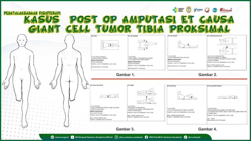 PENATALAKSANAAN FISIOTERAPI PADA KASUS  POST OP AMPUTASI ET CAUSA GIANT CELL TUMOR TIBIA PROKSIMAL
