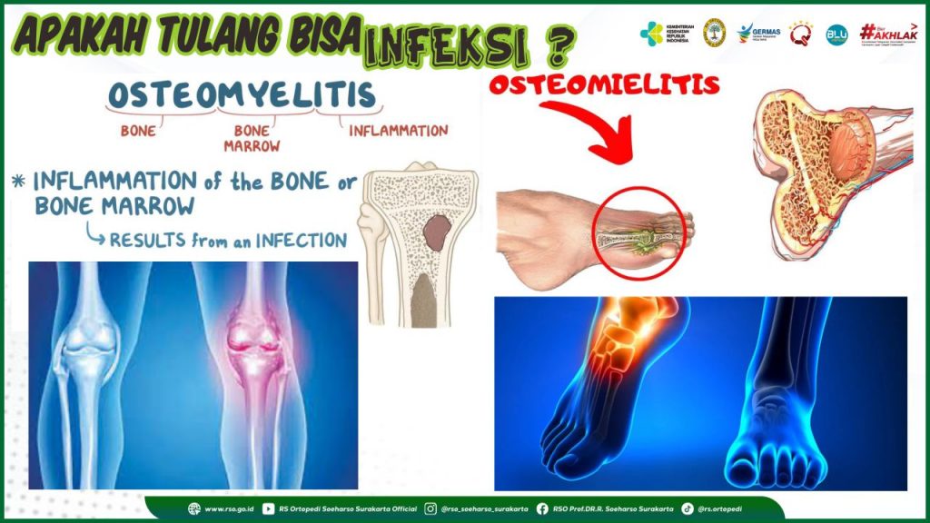 APAKAH TULANG BISA TERKENA INFEKSI ?