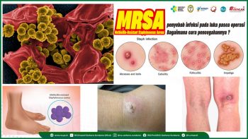 MRSA, penyebab infeksi pada luka pasca operasi, Bagaimana cara pencegahannya?