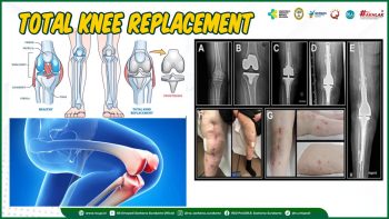 Penggantian Sendi Lutut Total (Total Knee Replacement)