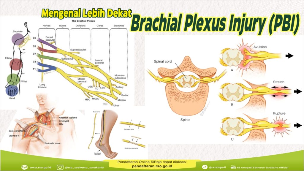 Mengenal Lebih Dekat Brachial Plexus Injury (PBI)