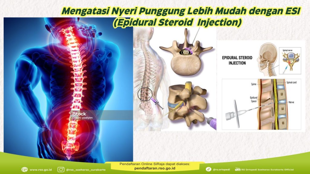 Mengatasi Nyeri Punggung Lebih Mudah dengan ESI (Epidural Steroid  Injection)