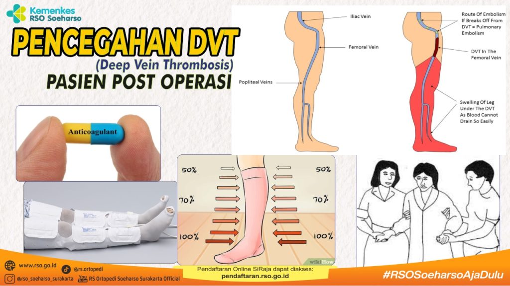 Pencegahan DVT (Deep Vein Thrombosis) pada Pasien Post Operasi